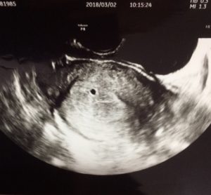 妊娠5週で胎嚢が見えない