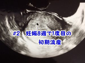 妊娠6週の胎嚢の見え方大きさ