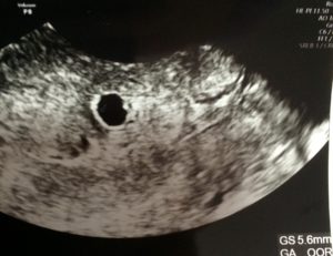 妊娠7週の胎嚢の大きさ