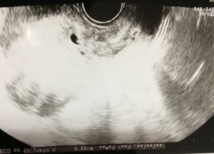 妊娠7週の胎嚢の大きさ2